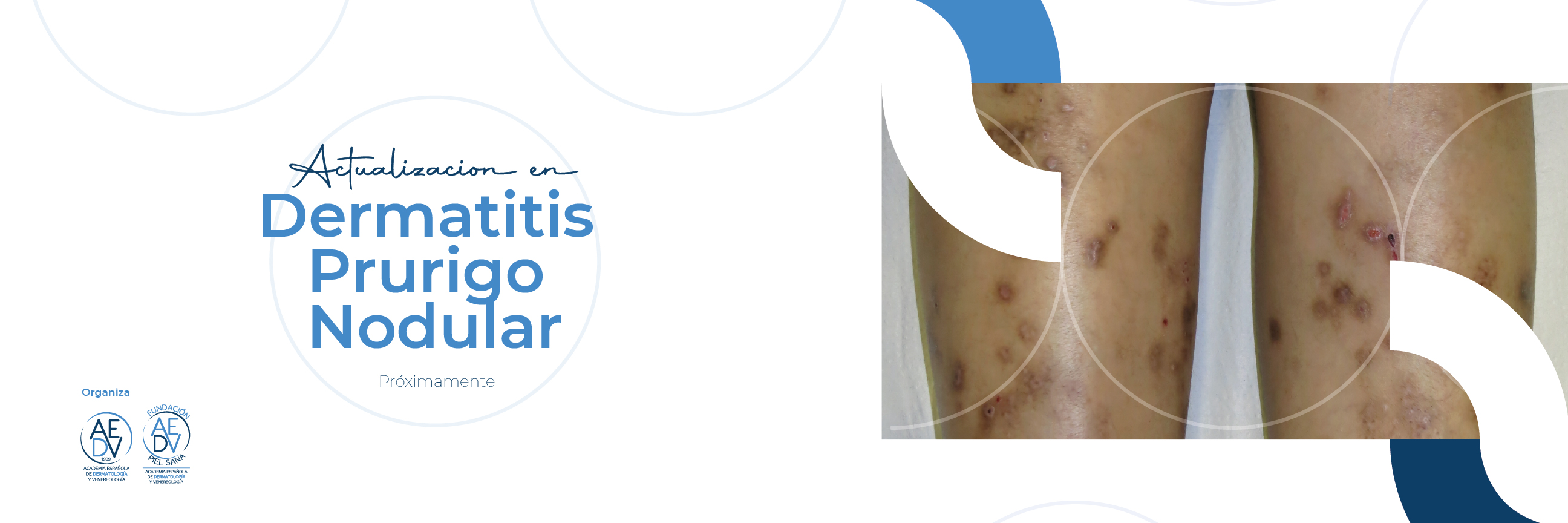 Actualización en Dermatitis Prurigo Nodular